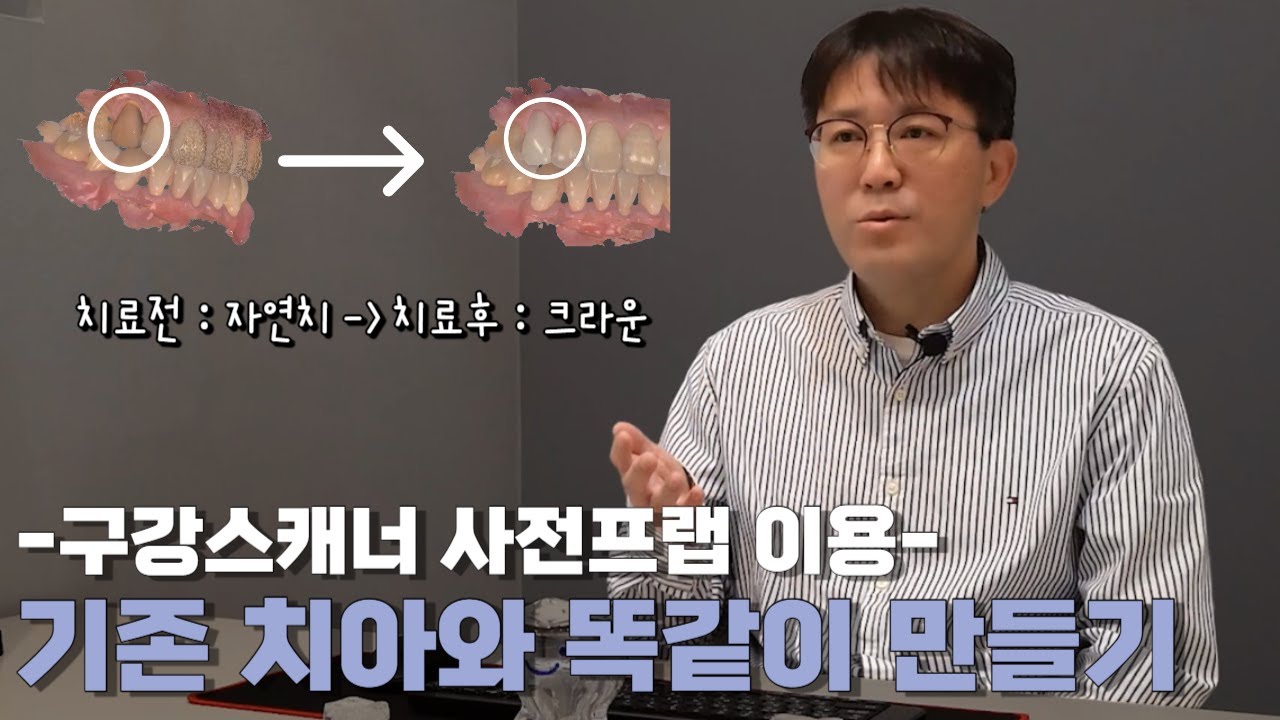 기존 치아와 똑같이 만들기 (구강스캐너 사전 프렙이용)ㅣMake the same as existing teeth (using oral scanner pre-prep)