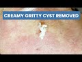 Upper back cyst removed  contour dermatology