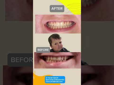 Before and after: Crooked front teeth straightened