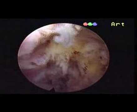 Percutaneous Laser Disc Decompression (PLDD) is the ultimate Remedy for Patients suffering from Neck. 