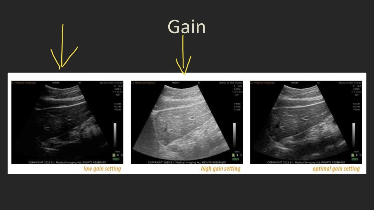 Ultrasound 101 Part 2 Basic Buttonology.mp4 YouTube