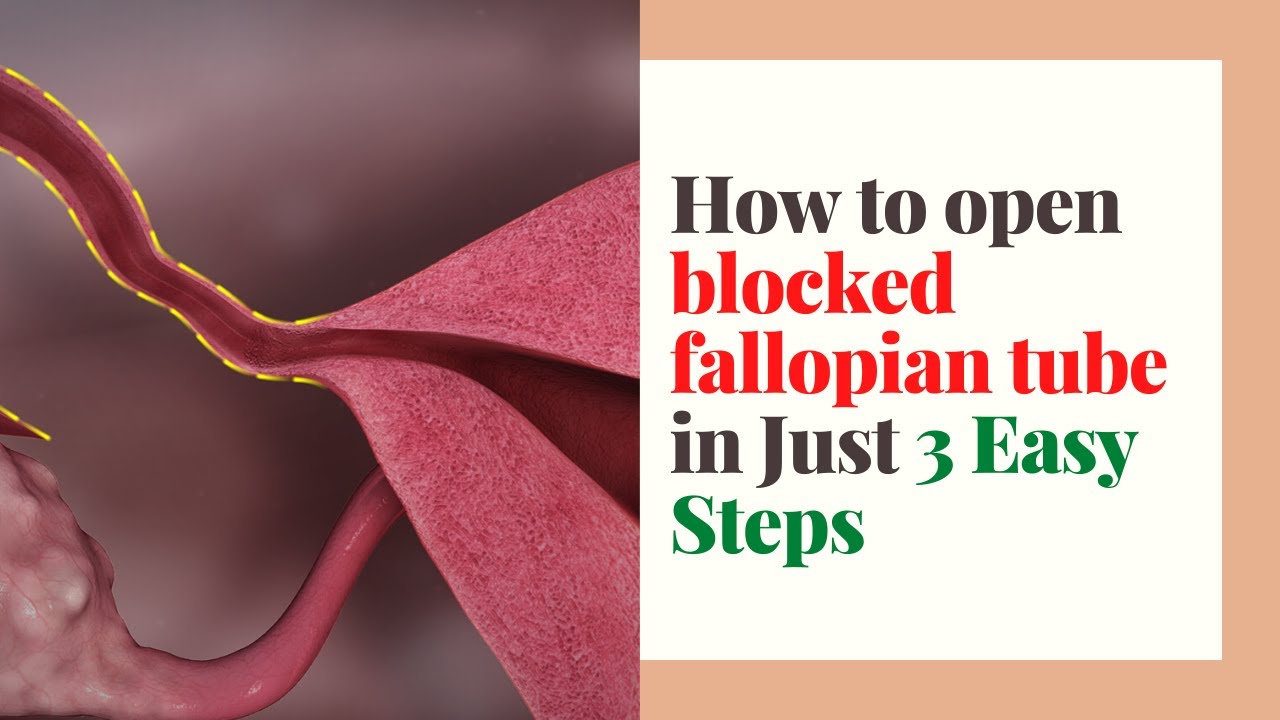 How to open blocked fallopian tube in Just 3 Easy Steps And Get Pregnant Naturally