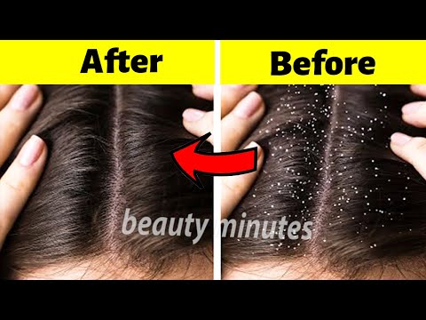 The strongest proven and guaranteed home remedy to eliminate the dandruff quickly
