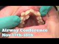 How and When To Treat A Narrow Palate