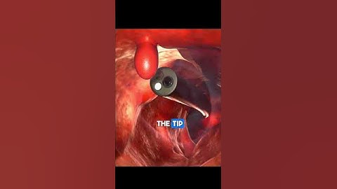 Colonoscopy | Dr. Paulien Moyaert