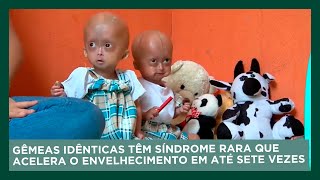 Gêmeas Idênticas Têm Síndrome Rara Que Acelera O Envelhecimento Em Até Sete Vezes Dom Espetacular