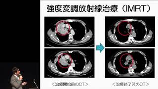 肺がんに対する高精度放射線療法　幸 慎太郎