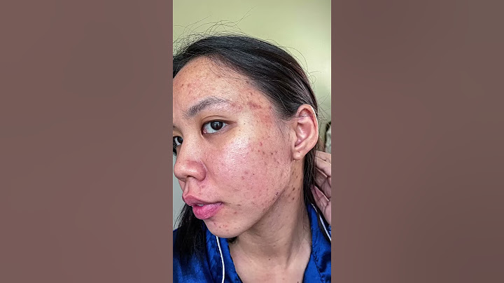 acne journey 🫶🥺 #shorts #acne #acnejourney #acneproneskin #acnetreatment