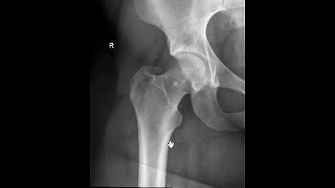 HOW TO DO A HIP ARTHROGRAM