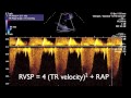 Transthoracic echo tte for beginners