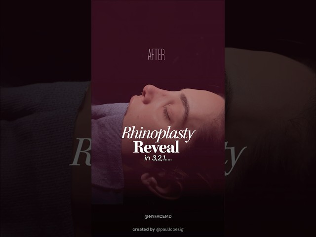 Rhinoplasty Reveal incoming… #beforeandafter #naturalresults