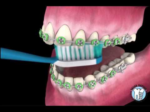Ortodontik Diş Fırçalama Tekniği ve Diş Teli Varken Dişler Nasıl Fırçalanır