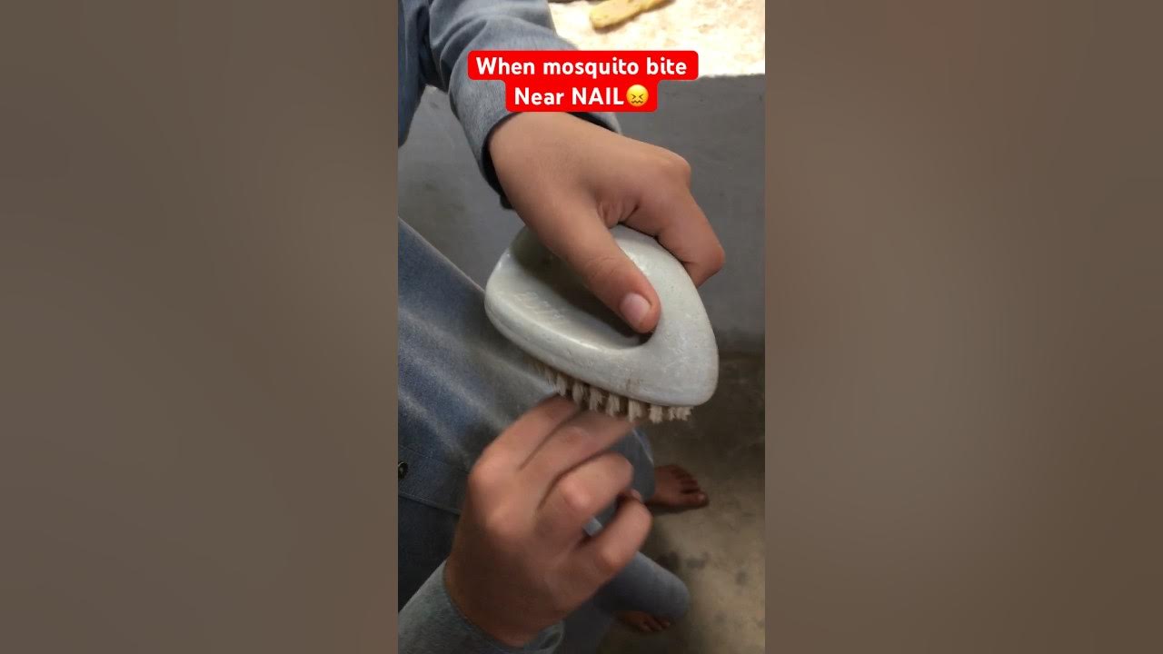 Mosquito Bite Near Eye Toddler
