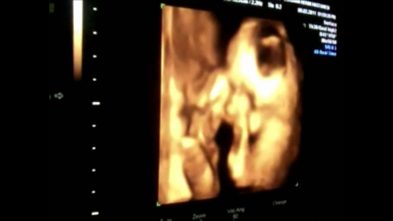 21 haftalık bebek 3 boyutlu ultrason göruntusu YouTube