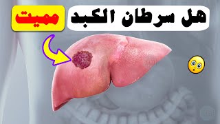 هل سرطان الكبد مميت ؟