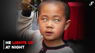 The Boy Who Glows in the Dark | Different People