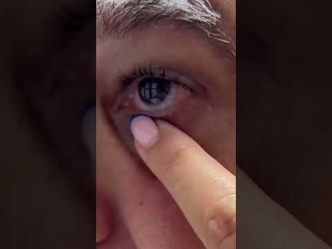 Video: Hoe om 'n sklerale lens in te voeg en te verwyder: 12 stappe (met foto's)