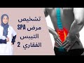 تشخيص مرض التيبس الفقاري SPA 