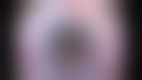 Mature cataract and Iris Hooks surgery