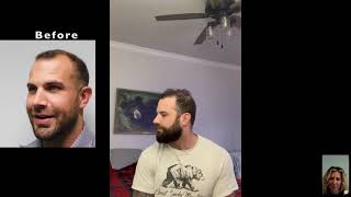 Remarkable Hair Transplant Results 1 Year After Hair Restoration Surgery in Fort Lauderdale
