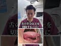 【舌癌】口内炎だと思ったら癌が発覚した患者の末路…【歯医者】