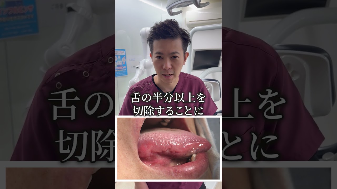 【舌癌】口内炎だと思ったら癌が発覚した患者の末路…【歯医者】