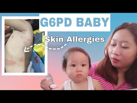 Baby Skin Allergies (G6PD) How to control the allergies ? Lamig | Singaw | Sipon | Pantal