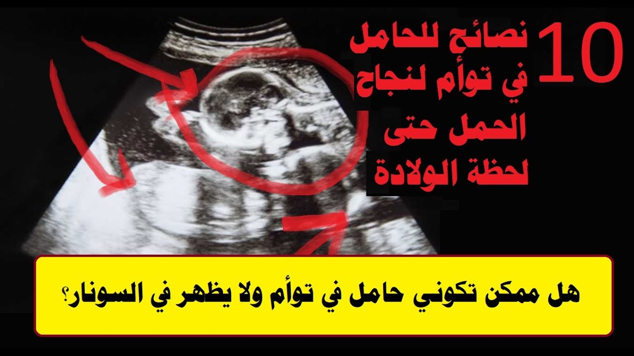 هل ممكن تكوني حامل في توأم ولا يظهر في السونار و10 نصائح للحامل في توأم لنجاح الحمل حتى لحظة الولادة Youtube