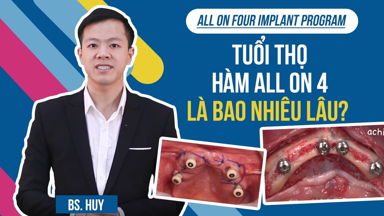 Outline Video Cấy răng implant cố định cả hàm all on 4 sử dụng được bao nhiêu năm