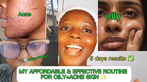 OILY + ACNE PRONE SKIN. AFFORDABLE AND EFFECTIVE Skincare Routine for oily and acne prone skin