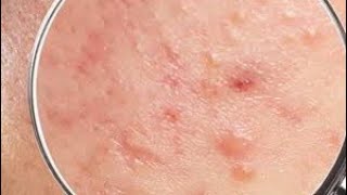 Big Cystic Acne Blackheads Extraction Blackheads & Milia, Whiteheads Removal Pimple Popping