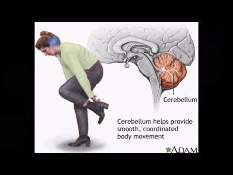 Cerebellar Gait Video - YouTube