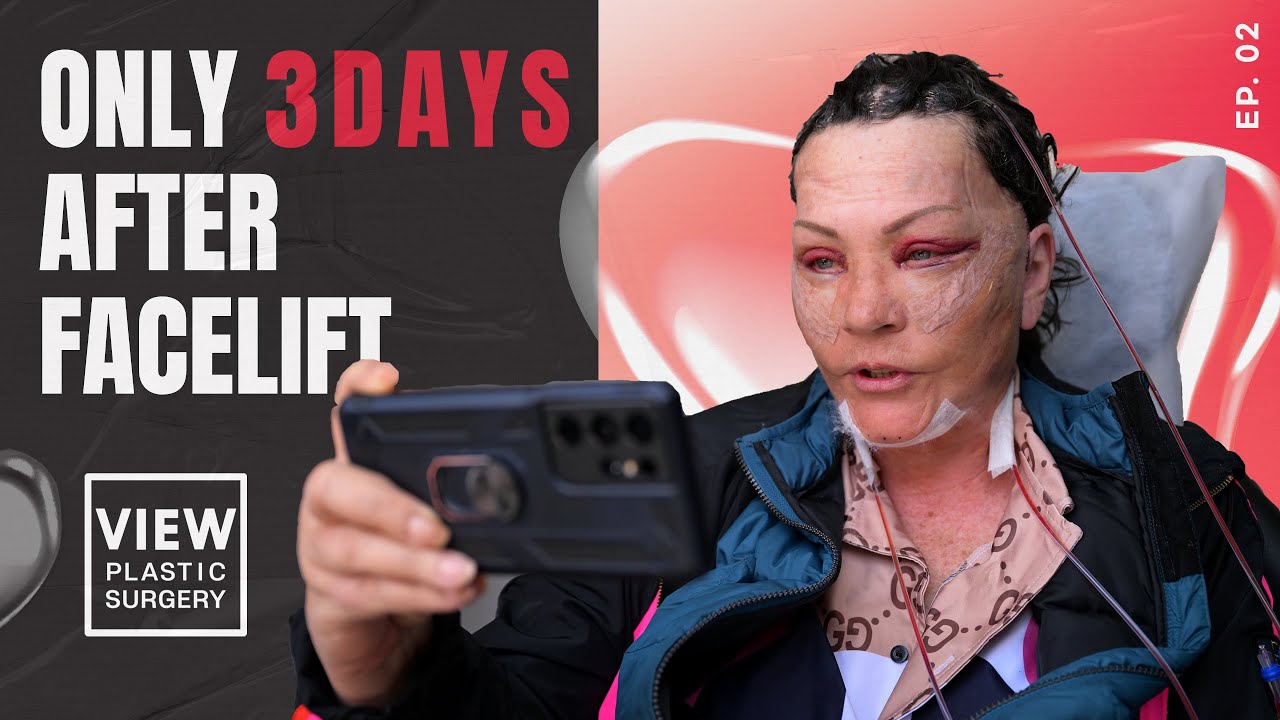 [Eng] 3 Days After Facelift #facelift #viewplasticsurgery