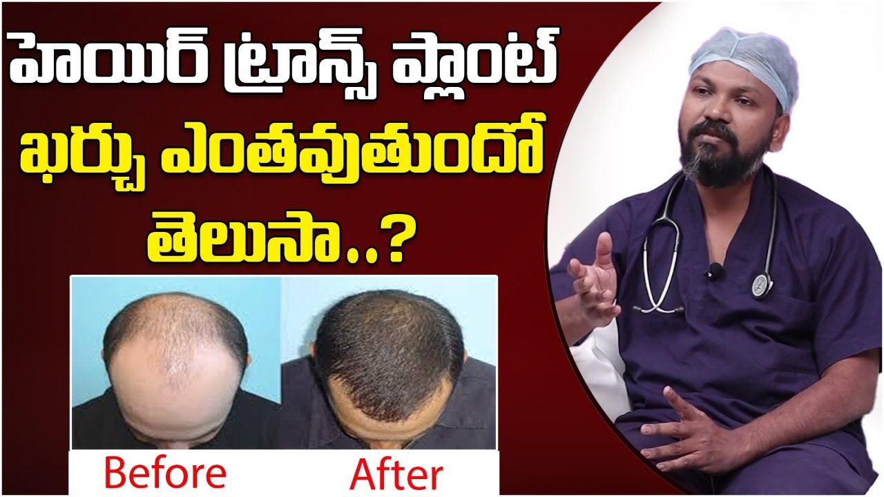 హెయిర్ ట్రాన్స్ ప్లాంట్ ఖర్చు ఎంతో తెలుసా? ||Hair Transplant Cost In Hyderabad 2021| #HairTransplant
