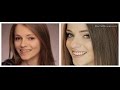 Aesthetic rehabilitation. Non invasive ceramic veneers.