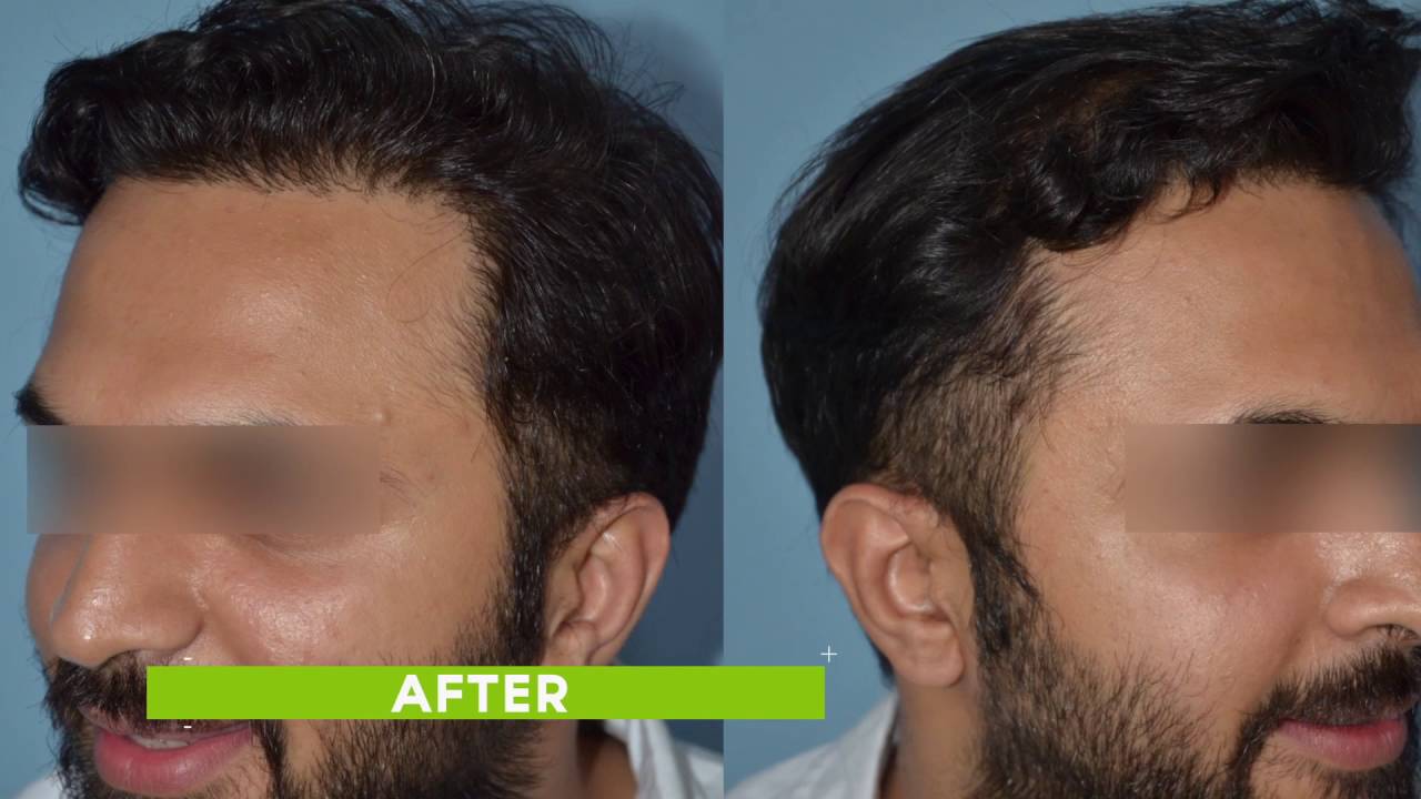 Hair Transplant by Dr. Bhatti at Darling Buds, Chandigarh, India - YouTube