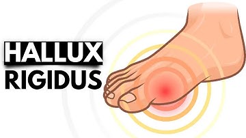Hallux Rigidus: The Stiff Big Toe Condition and Treatment Options