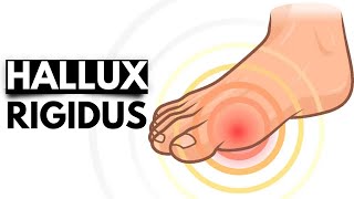 Hallux Rigidus: The Stiff Big Toe Condition and Treatment Options