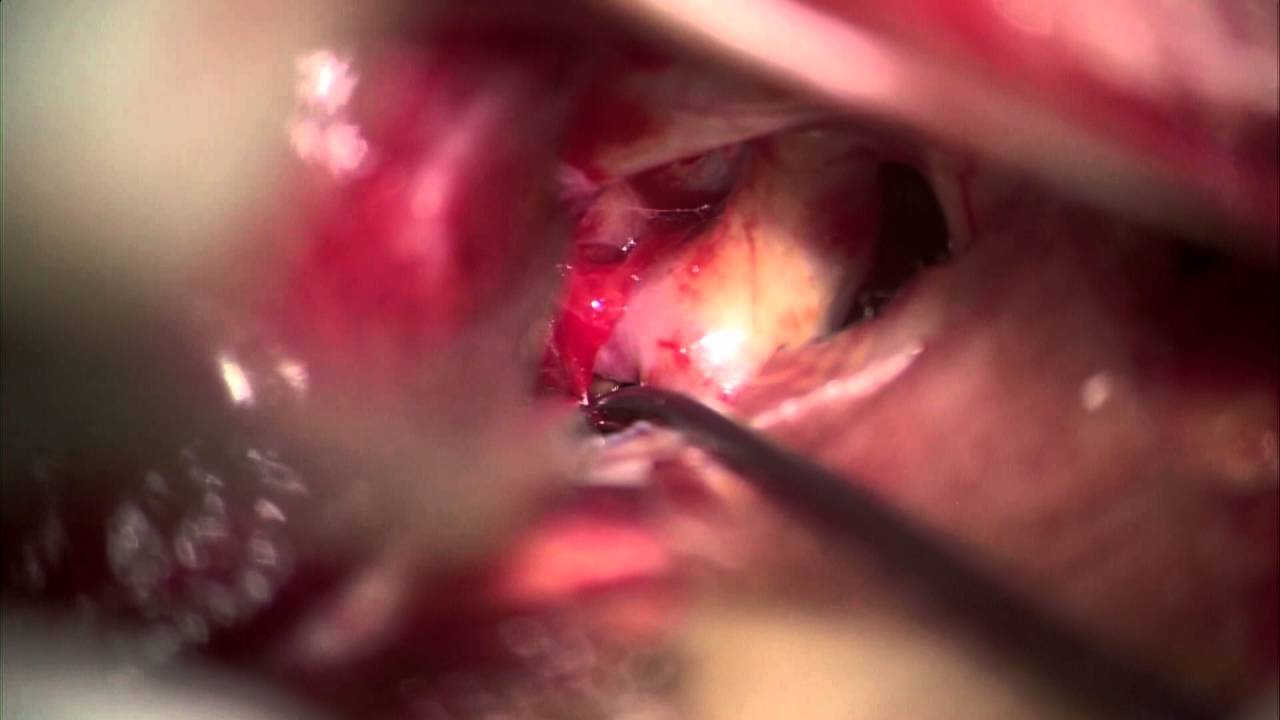 Left Posterior Communicating Artery Aneurysm Clip (II)
