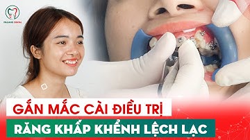 Quy Trình Gắn Mắc Cài Điều Thị Răng Khấp Khểnh Lệch Lạc.