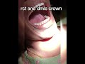 rct and dmls crown.#dentist #dentaltreatment #dentalclinic #dentalcrownprocedure #rootcanaltreatment