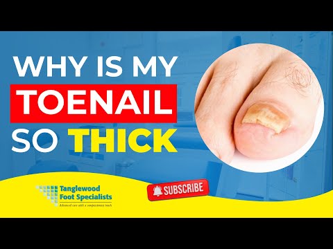 Video: De ce unghiile de la picioare devin groase?