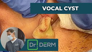 Vocal Cyst | Dr. Derm