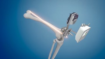 Total Knee Replacement 3D Surgical Animation - KneeAlign