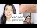 गर्मियों में छोटी फुंसी का इलाज - Small Bumps in Summer Home Remedies