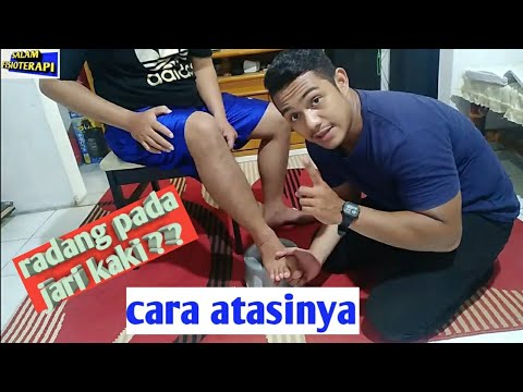 Video: Jari Kaki Terkilir: Gejala, Penyebab, Pengobatan, Waktu Pemulihan, Dan Mor