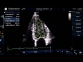 Ejection fraction measurement