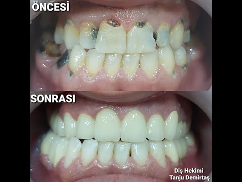 zirkonyum ve e-max kaplama diş nedir?