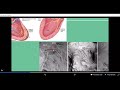 HIS BUNDLE PACING