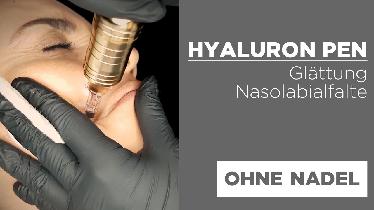 Aufpolsterung Nasolabialfalte Mit Hyaluron Pen Anti Falten Booster Youtube